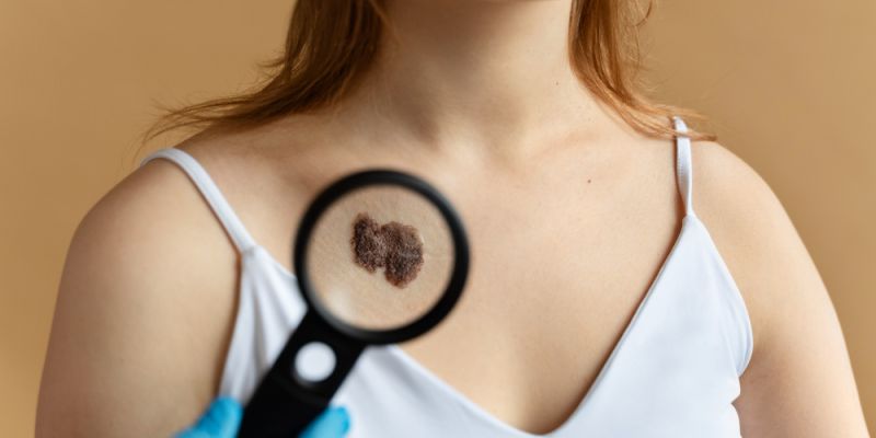 Rak skóry – jeden z najczęściej diagnozowanych nowotworów na świecie