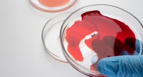 „Choroba królów” wciąż obecna. Na Mazowszu ponad tysiąc pacjentów z hemofilią